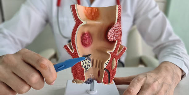 What is Private Anal Fistula Surgery and How it Helps