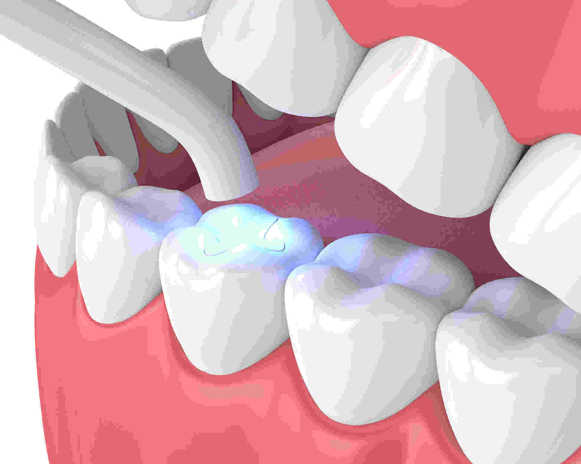 Are Tooth Sealants Safe for Children in Arlington?