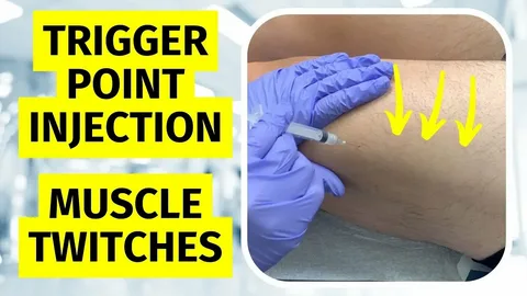 trigger point injection