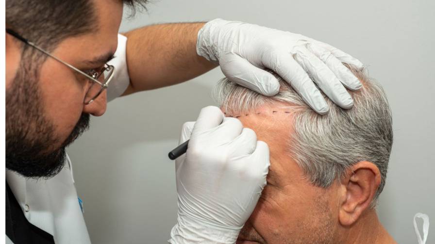Why People Choose ILHT for the Best Hair Transplant?