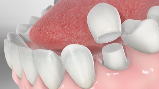 Precision Fit Crowns: Strength, Seal, and Stability