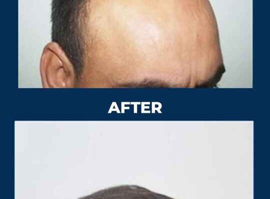 Hair Transplant 07 12 2024 1 1 1 1