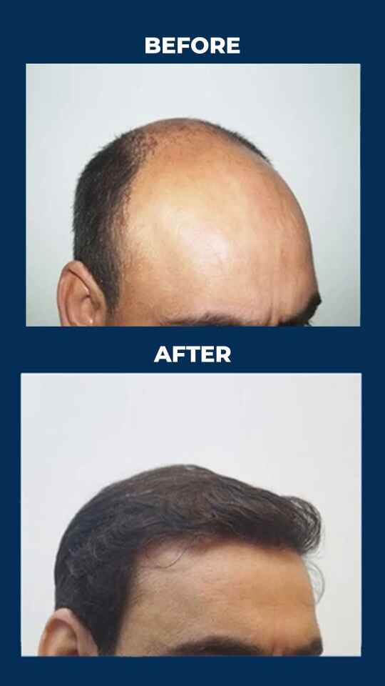 Hair Transplant 07 12 2024 1 1 1 1