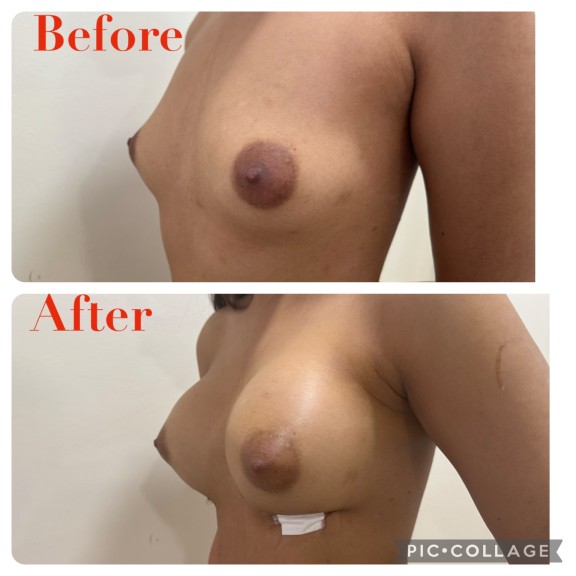 Plastic Surgery Cost Near Me In Hyderabad
