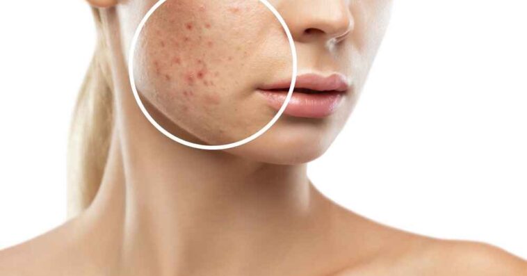 Scars Laser Treatment in Delhi