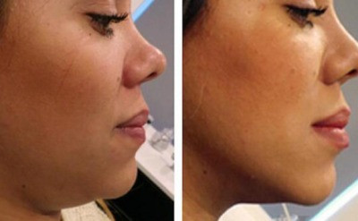 botox chin before and after results in New Lenox IL showing smoother balanced chin