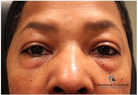 Eyebag Removal: Restore Your Natural Glow with Chandler