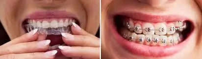 Exploring Options in Modern Advanced Bite Correction