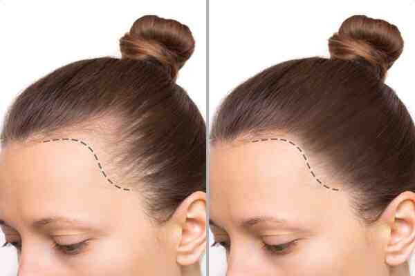 Scalp Tattoo near Vancouver: Realistic Hairline Restoration with Micropigmentation 1 mmc smc4 11 1
