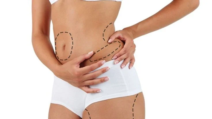 Liposuction in Islamabad